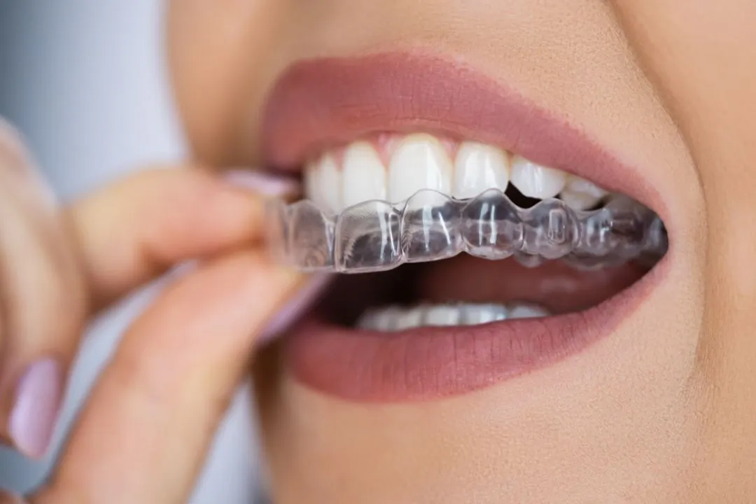 Clear Aligners and Braces Treatment
