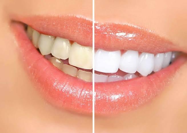 Teeth Whitening Procedure