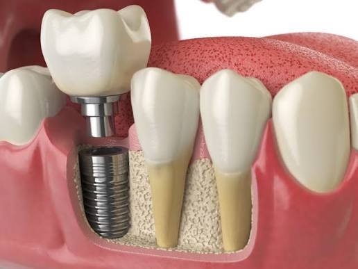 Dental Implants Procedure at Mouth & Teeth Clinic