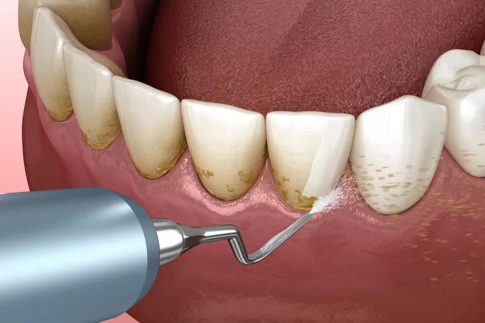 Scaling and Teeth Cleaning